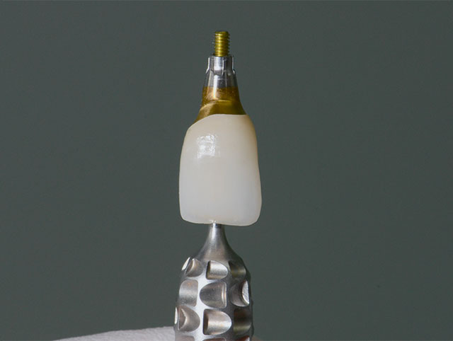 Implant with white ceramic body, threaded brass top and textured silver-colored metal base against dark background.