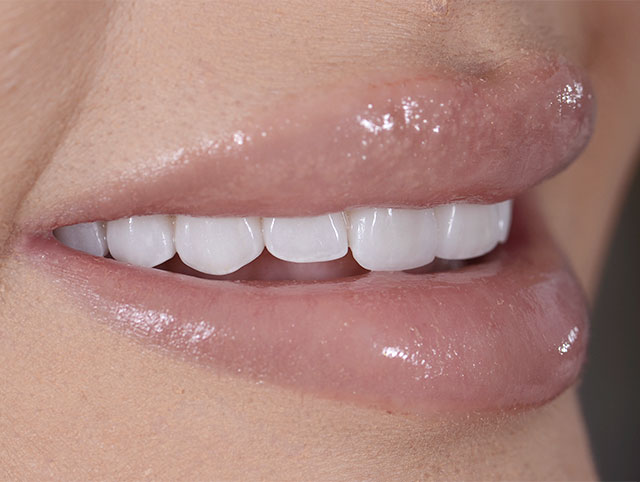 Close-up of feldspathic veneers