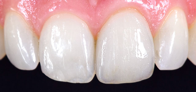 Close up of Single Feldspathic Porcelain Veneer.