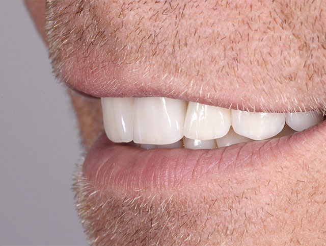Close up of Multiple single Feldspathic Porcelain Veneers.